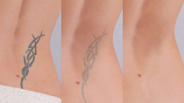 page-header_saline-removal